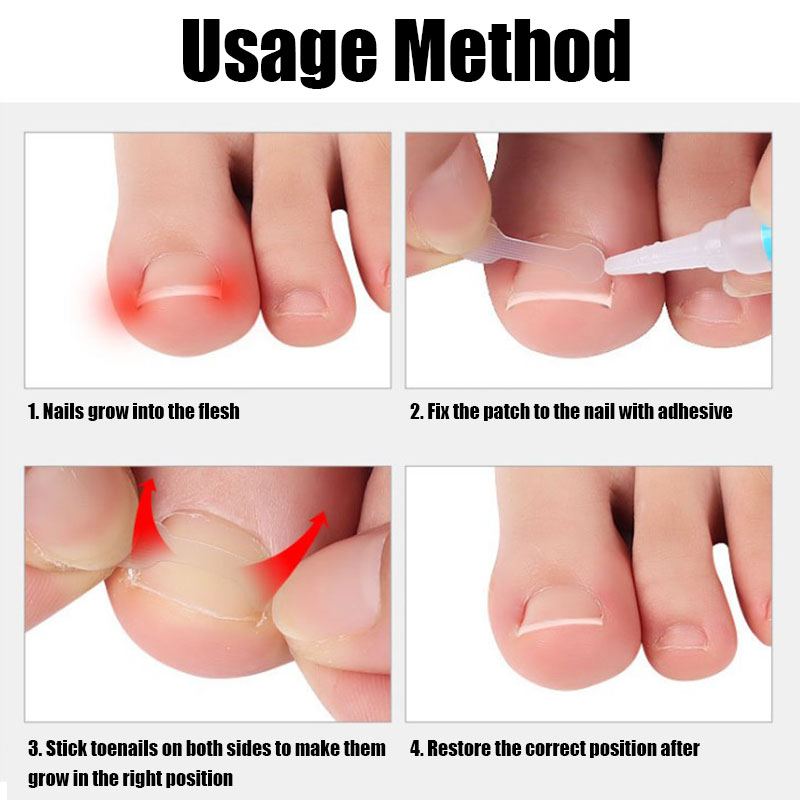 10~30Pcs Ingrown Toe Nail Treatment Ingrown Toenail Correction Tool Elastic Patch Sticker Straightening Clip Brace Pedicure Tool