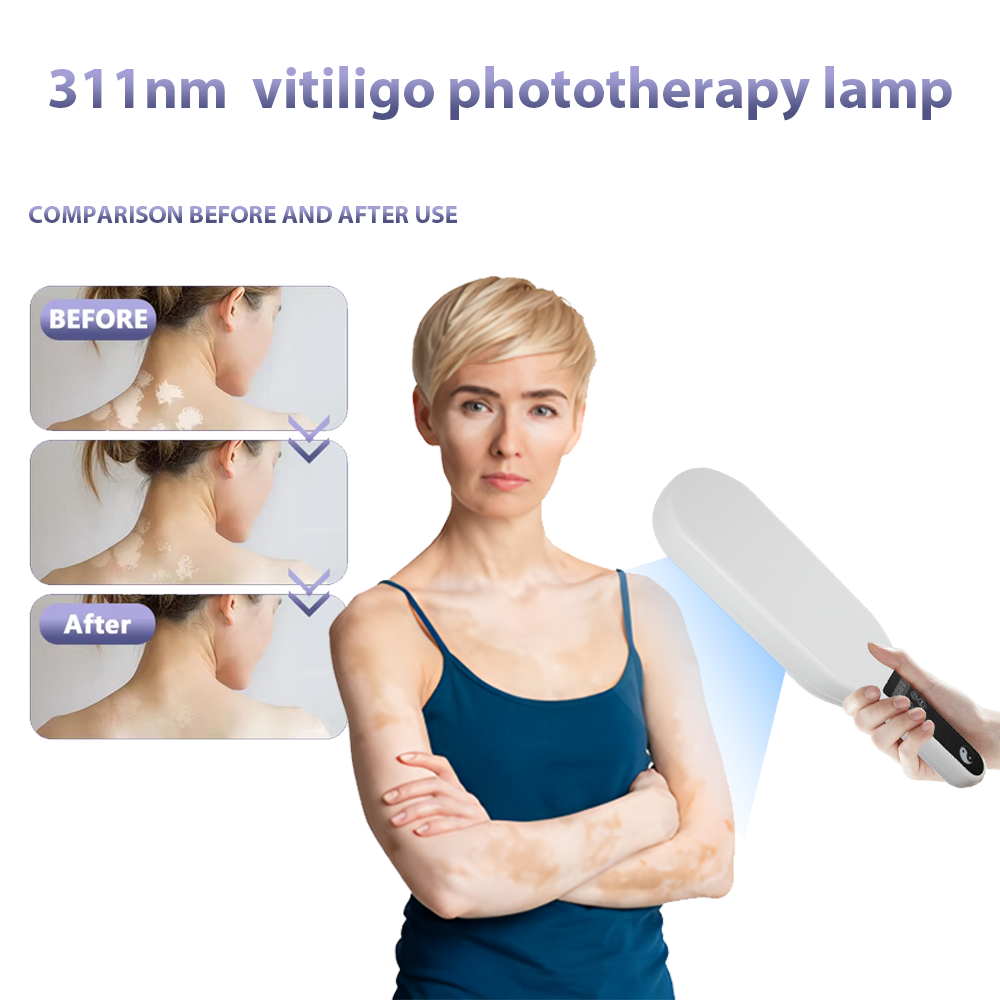 311NM UVB Narrow Band UV Light Source Treatment Vitiligo Psoriasis Eczema Therapy Lamp Ultraviolet Phototherapy Instrument