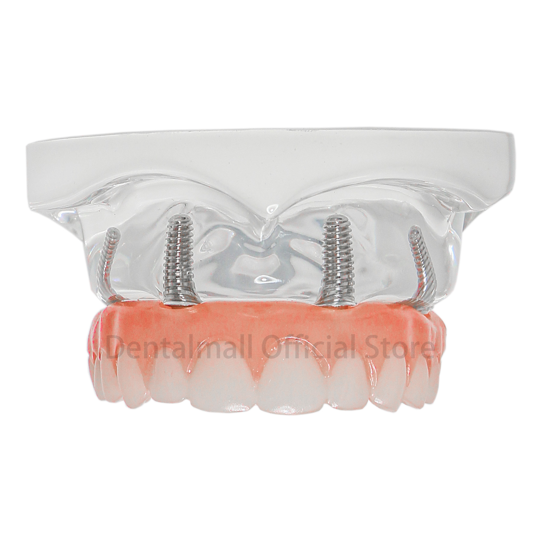 Teeth Model Upper Jaw Implant Restoration Model 4 Screws with Post Core Bridges