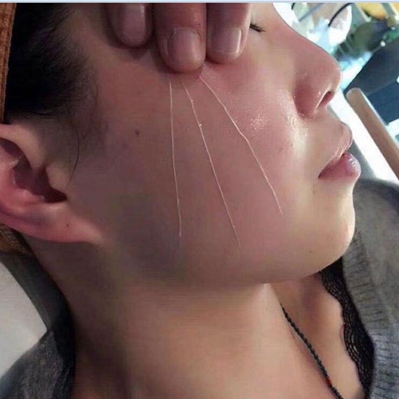 50bag Radar Thread No Needle Silk Fibroin Line Carving Essence Collagen Facial Thread Lift Anti Aging Hyaluronic Tightening Skin