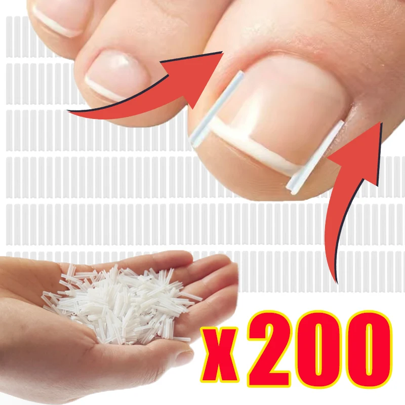 Ultra-thin Ingrown Toenail Corrector Tools C-shaped Tube Pad Correcting Nails Growth Paronychia Treatment Recover Pedicure Tools