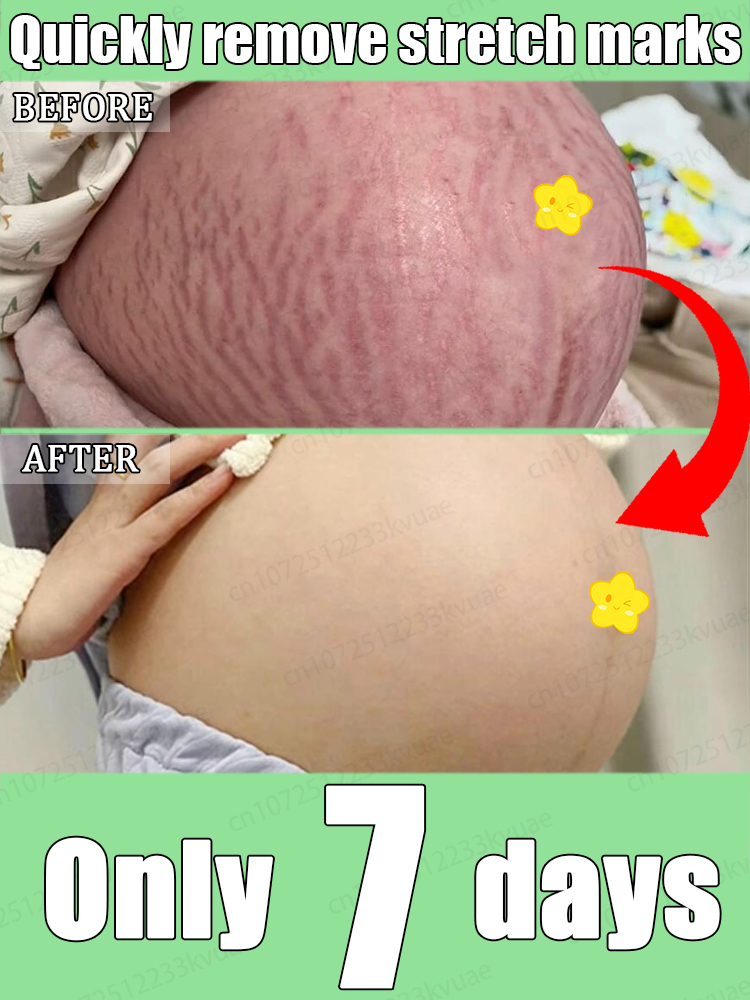 Say goodbye to stretch marks. Prevent and remove stretch marks and get rid of scars quickly